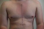 scars-on-hamish-chest-after-surgery-data